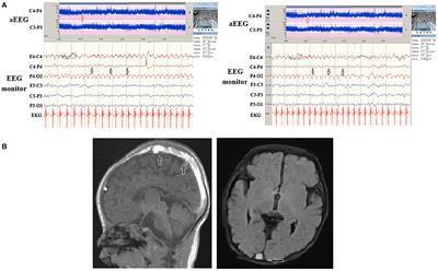 Amplitude Integrated Electroencephalography and Continuous Electroencephalography Monitoring Is Crucial in High-Risk Infants and Their Findings Correlate With Neurodevelopmental Outcomes